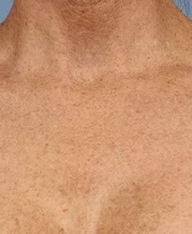 laser resurfacing snoqualmie  OR CALL US DIRECTLY 1-888-668-8262