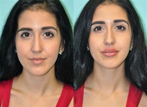 lip augmentation omaha  See before and after photos of patients from Omaha Facial Plastic Surgery & Medspa