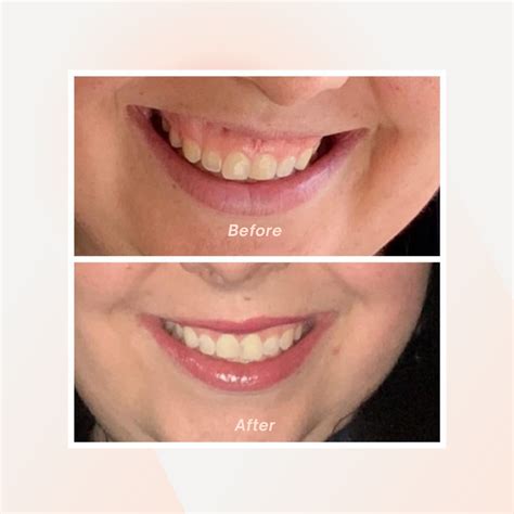 lip augmentation omaha  Orr, our plastic surgery team, plastic surgery procedures and more