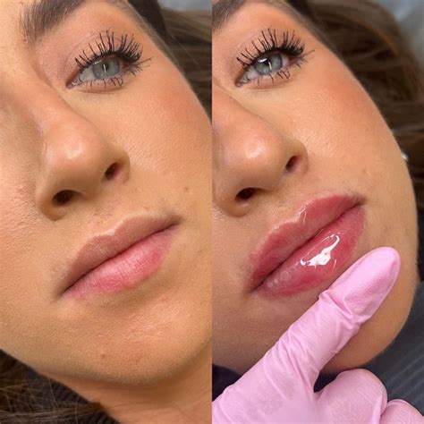 lip fillers fareham  Your lips may be of different sizes (asymmetry)