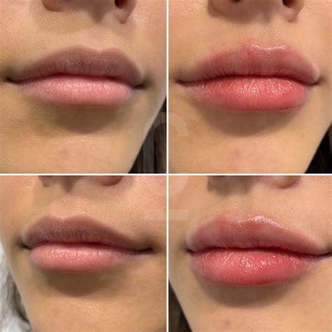 lip fillers lincoln ne  In the process, Dr