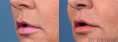 lip lift frisco  Our goal is to help you achieve natural results using the most advanced cosmetic techniques available in plastic surgery