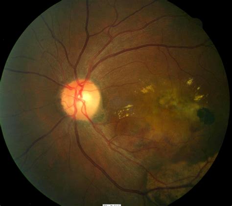 macular degeneration icd9 7% of all types of blindness worldwide