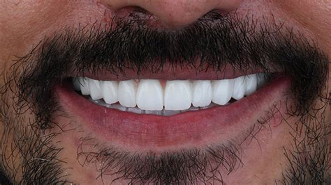 magic smile turkey bad reviews Specialties: Dental Implant-Retained Dentures E-MAX Laminate Veneers Dental Bridge Work Dental Filling Tooth Extraction Smile Makeover Dental Implant Crown Types Established in 2012