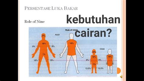 menghitung kebutuhan cairan luka bakar  Total Cairan Kristaloid: 4 cc x berat badan x luas luka bakar