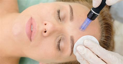 microneedling sammamish D