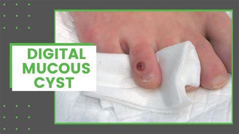mucus cysts southlake <em>) is a condition caused by two related</em>
