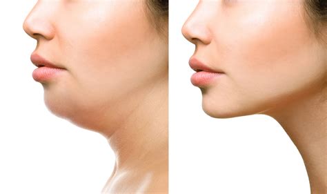 navarre kybella injections  The injectable procedure is an alternative to surgical techniques like liposuction