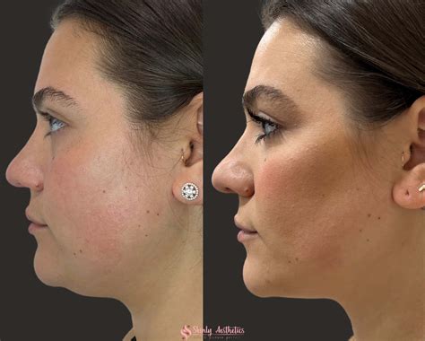 navarre kybella treatment The FDA approved Kybella injections in 2015 for the reduction of excess fat accumulated under the chin