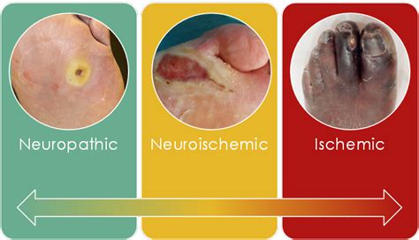 neuroischemic foot ulcer icd 10 1 Non-pressure chronic ulcer of thigh