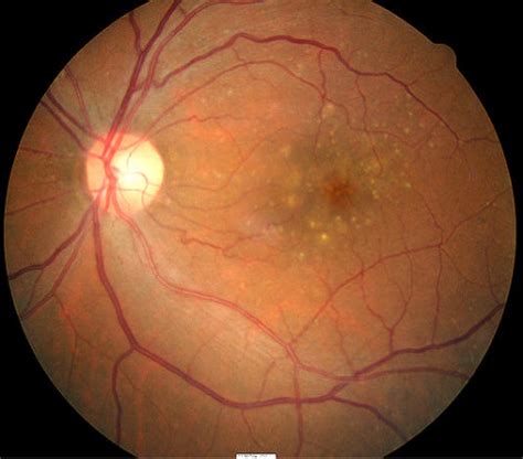 nonexudative age related macular degeneration icd 10  ICD 10 code for Nonexudative age-related macular degeneration, bilateral, advanced atrophic with subfoveal involvement