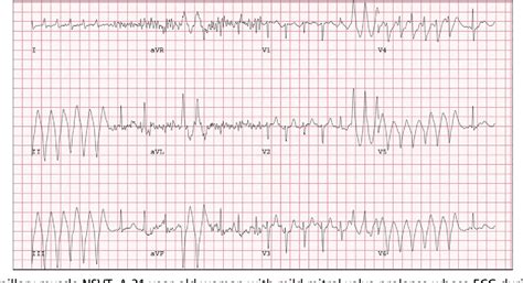 nonsustained ventricular tachycardia icd10  Ventricular Tachycardia Ventricular tachycardia is a rapid heart rate in the lower chambers of the heart, the ventricles