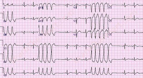 nonsustained ventricular tachycardia icd10 ICD-10-CM Code