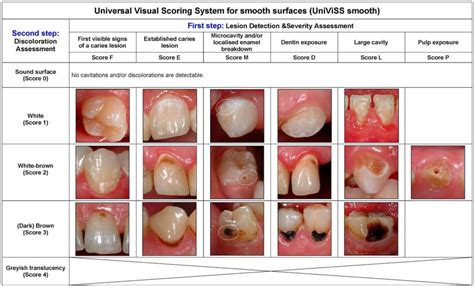 of the caries putas  Although caries has significantly decreased for most Americans over the past five decades, disparities remain among some population groups