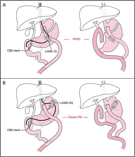 pancreaticoduodenectomy icd 10  Johnson MD, Rupen Amin MD, in Surgical Pitfalls, 2009 INTRODUCTION