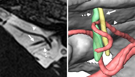 paroxysmia 5 mm, with symptomatic neurovascular compression typically