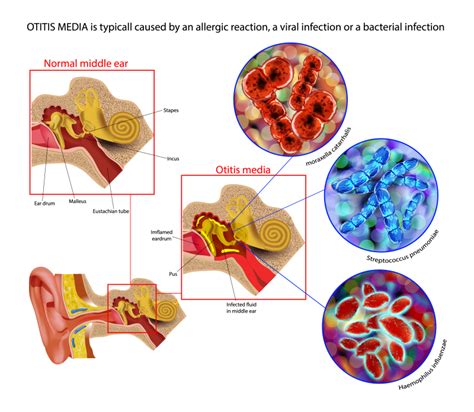 patofisiologi otitis media akut 1 Otitis Media Supuratif Kronik 2