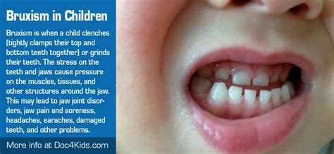 pediatric bruxism treatment in lake stevens 8%)