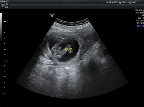 peek a baby gender scan  I'm really nervous because I feel so not pregnant, and so normal