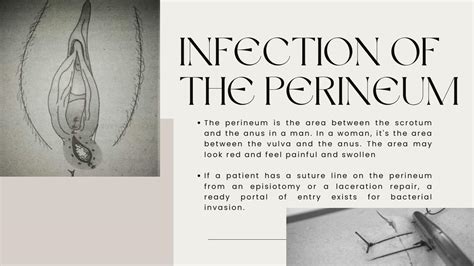 perineal raphe irritation  Median raphe cysts present anywhere between the external urethral meatus and the anus