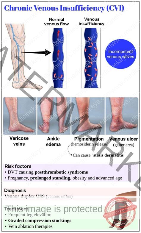 peripheral venous insufficiency icd 10  Postphlebitic syndrome may affect 20 to 50% of patients with deep venous thrombosis Deep Venous Thrombosis (DVT) Deep venous thrombosis (DVT) is clotting of blood in a deep vein of an extremity (usually calf or thigh) or the pelvis