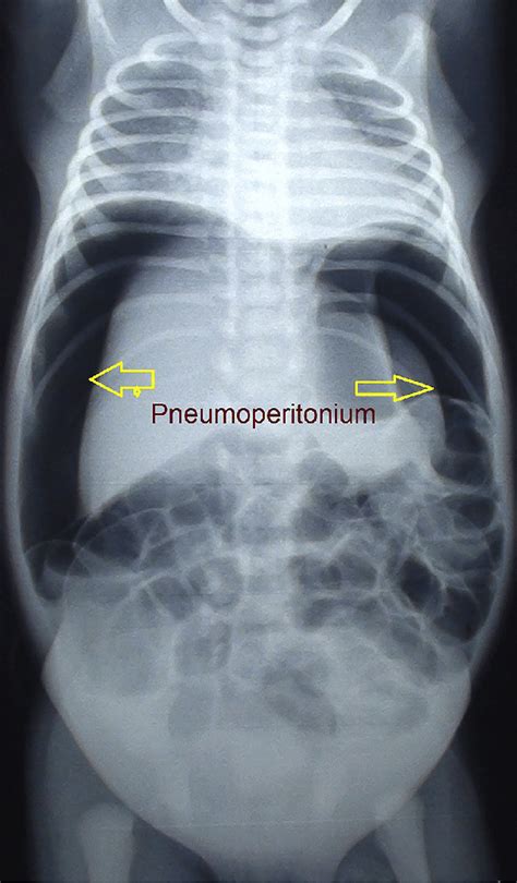 peritonitis x ray  severe and generalized abdominal pain (upper) gradual and localized pain (lower) anorexia, nausea and vomiting