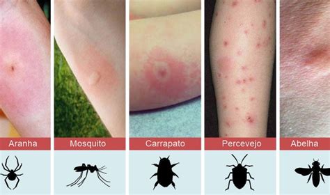 picada inseto vermelhidão inchaço remédio caseiro  A coceira na pele é um