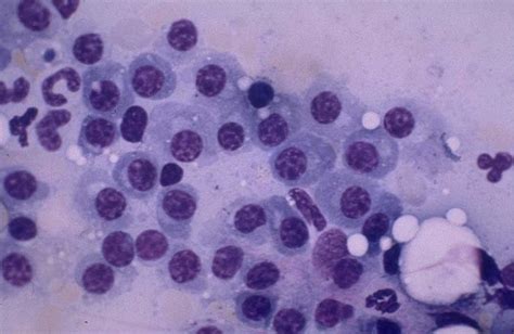 plasmacytomas dog paw (11) While they most often occur in the skin and mucus membranes, tumors of the abdominal viscera do occur, albeit with much less frequency