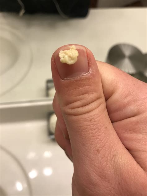 popcorn shell stuck in tonsil  feels like popcorn kernel stuck on back of tongue 09 Jun