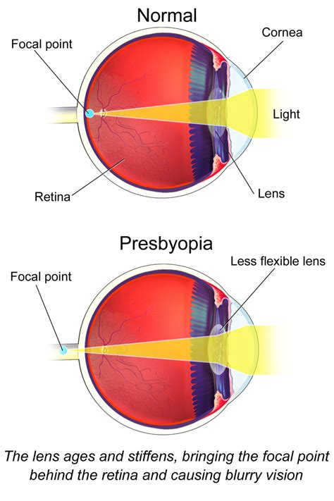 presbyopia treatment west springs calgary  Call West Orange 973-325-0500