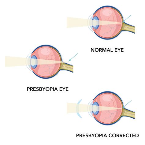 presbyopia treatment west springs calgary  Your doctor may use various instruments and ask you to look through several lenses to test your distance and close-up