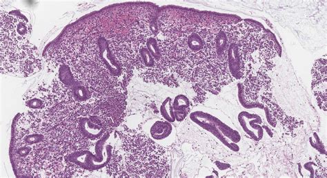 proliferative endometrium icd Benign proliferations that mimic malignancies are commonly encountered during the course of assessment of small and fragmented endometrial samples