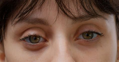 ptosis mata  Diplopia memiliki diagnosis banding yang sangat luas