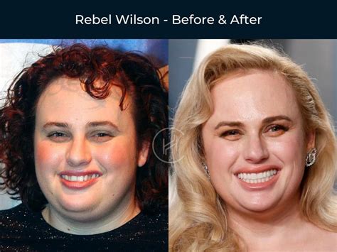 rebel wilson veneers Photo: Rebel Wilson/Instagram