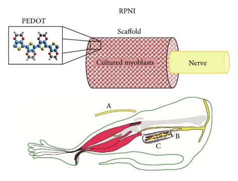 regenerative peripheral nerve interface cpt code The aim of this study is to evaluate the prophylactic RPNI efficacy in managing post-amputation pain and neuroma formation in amputees compared with patients in which lower limb amputation was performed without this procedure