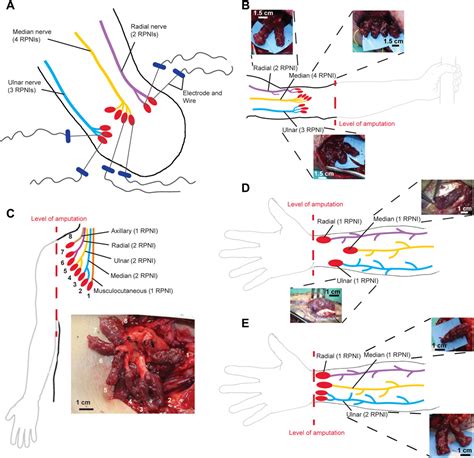regenerative peripheral nerve interface cpt code  doi