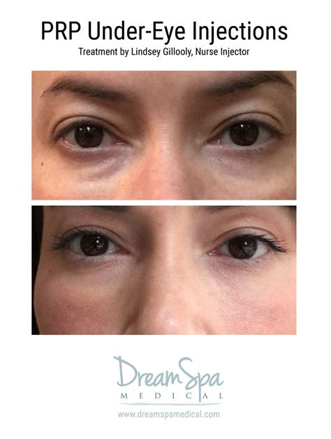 restylane lyft brookline  Previous studies have shown promising results with regard to Restylane and Restylane Lyft when used as a scaffold for REPs in vitro [25,26]