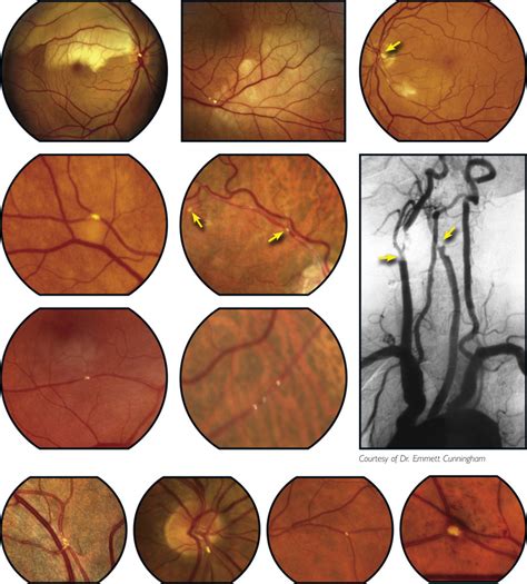 retinal disorders in diseases classified elsewhere Retinal disorders in diseases classified elsewhere