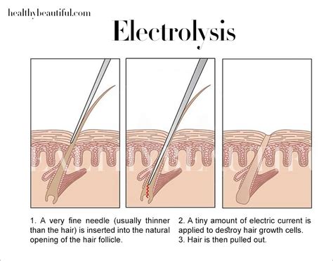 reveal bk electrolysis  More