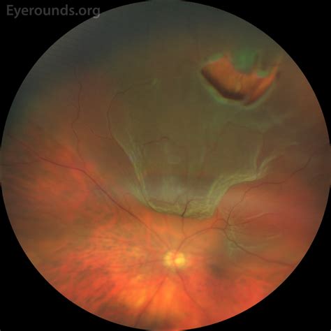 rhegmatogenous retinal detachment icd 10 1136/ bmjophth-2020-000474 Received 30 March 2020 Revised 17 July 2020 Accepted 20 July 2020 1Ophthalmology, Royal Liverpool and Broadgreen Hospitals NHS Trust, Liverpool, UK 2UOSD Glaucoma, Arcispedale Immediate treatment is imperative if rhegmatogenous retinal detachment is acute and threatens central vision