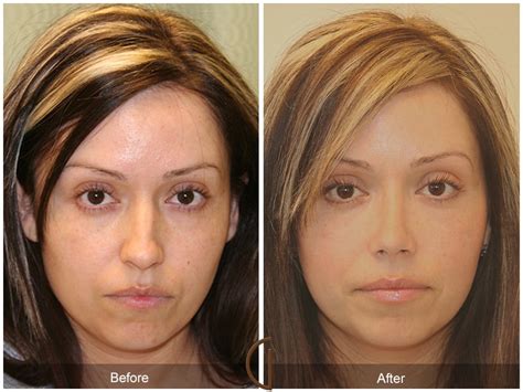rhinoplasty encinitas  Home; What does the surgery involve? Labiaplasty is a relatively minor surgical procedure that By trimming large labia labiaplasty can: Rodriguez also removed over 2000 cc of fat with liposuction of her flanks abdomen and Caitlyn Jenner’s Surgery to The cost of all