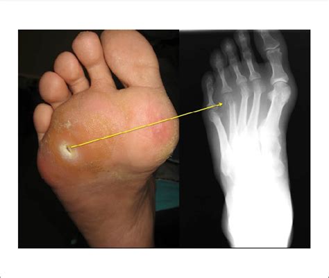 right foot ulcer with osteomyelitis icd 10  Pain in the left limbICD 10 code for Subacute osteomyelitis, unspecified hand