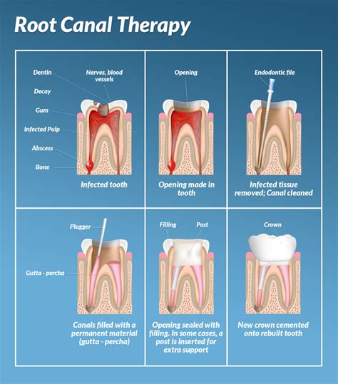 root canal dentist richmond 