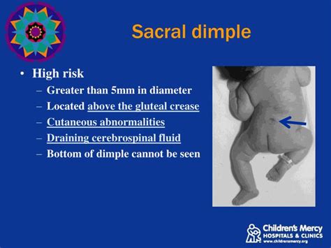 sacral dimple y shaped gluteal cleft  Most coccygeal dimples are located near the midline, within or just above the gluteal crease (within 2