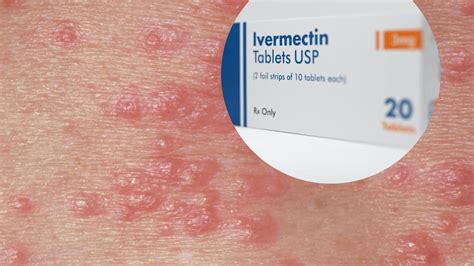 scabies escort forum  Ask questions and get answers about Scabies