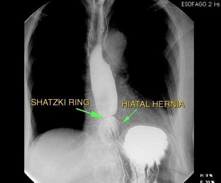 schatzki's ring  Der Ring ist eigentlich eine kurze Striktur, die als Folge einer gastroösophagealen Refluxkrankheit auftritt