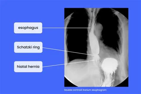 schatzki ring symptoms  Acute full thickness