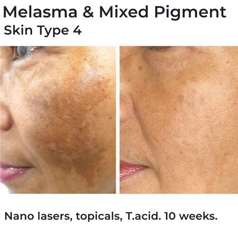 set trị nám fei melasma  Tinh chất làm mờ nám và nếp nhăn Paula’s Choice Clinical 1% Retinol Treatment