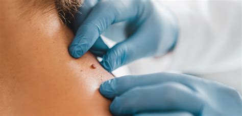 skin tag removal west wickham  Electrosurgery: Burning off the skin tag with high-frequency electrical energy