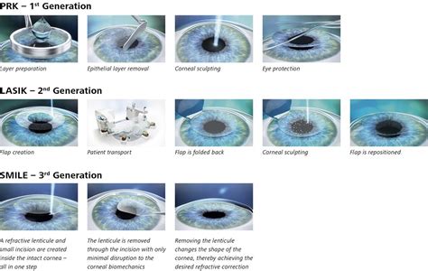 smartsight vs lasik  SmartSight